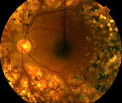 Back of the eye after laser